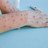 Mpox: Spermien begünstigen Infektion Symbolbild: Mpox-Infizierte Arme und Hände