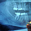 Zahnschmelzabbau durch Quarz-Staub
