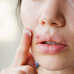 Aciclovir-Tablette ist rezeptfrei Aciclovir-Tablette ist rezeptfrei