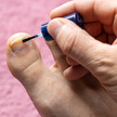 Nagelpilz: Neue Behandlungsoption ab Mai Foto: Eine Person mit mildem Nagelpilz am rechten Zeh trägt ein Präparat auf