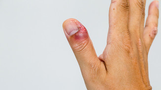 Nagelbettentzündung: So heilt sie schneller ab Nagelbettentzündung: So heilt sie schneller ab