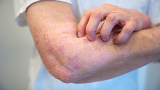 Neurodermitis: Studie prüft Therapie im 12-Wochen-Rhythmus Neurodermitis: Studie prüft Therapie im 12-Wochen-Rhythmus