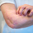 Nemluvio: Neue Therapieoption bei Juckreiz Foto: Eine Person hat gerötete, schuppende Stellen am Arm.