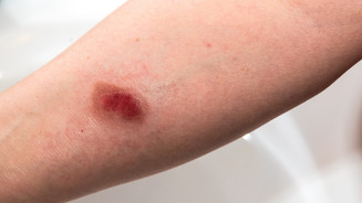 Wundbehandlung: Erstattung bis Ende 2026 Symbolbild: Arm mit Brandwunde