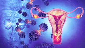 Neues Mittel gegen Endometriose entwickelt