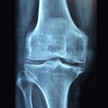 knie knochen roentgen pixabay Romosozumab erhöht Knochenmineraldichte
