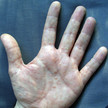 hand Dyshidrosis wiki inwe ccbysa30 Handinnenflächen mit dyshidrotischem Ekzem