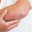 Psoriasis: Erhöhtes Risiko für MS-Patienten Foto: Schuppenflechte (Psoriasis) am Ellbogen