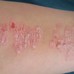 Psoriasis: Tremfya besser als Cosentyx Psoriasis: Tremfya besser als Cosentyx