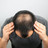 Minoxidil-Wirkung: Plateau nach sechs Monaten Minoxidil-Wirkung: Plateau nach sechs Monaten