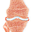 Glucosamin bei Gonarthrose: Eine heterogene Wirkstoffgruppe